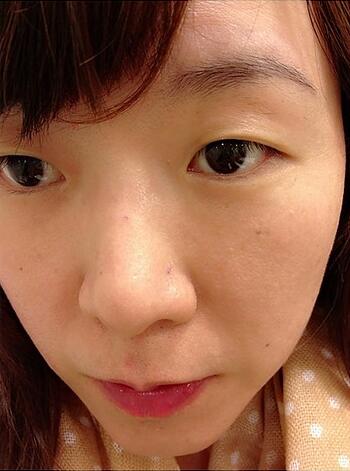 去上海伊美尔港华询问光子嫩肤后，体验了一个疗程