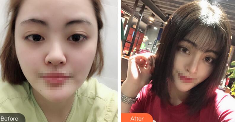 【介绍】上海鲁南做鼻部手术怎么样？历时2个月终于恢复漂亮了