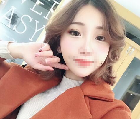 合肥褚燕军祛眼袋介绍，别留着你的眼袋过新年！