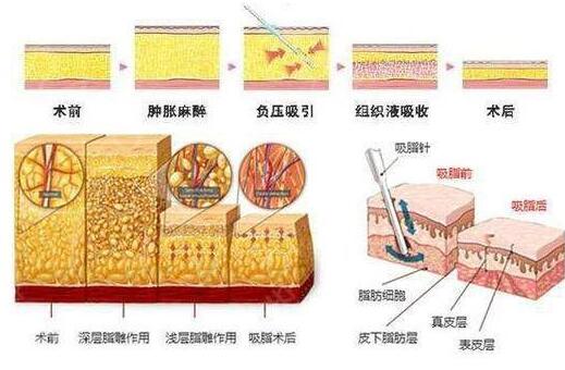 涨知识|大腿吸脂手术恢复期多久？