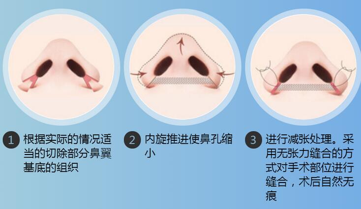 鼻头鼻翼缩小整形的具体方法是什么？手术步骤