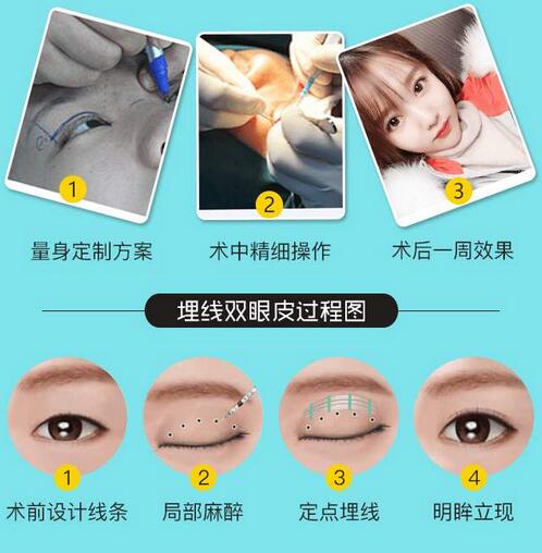 埋线双眼皮多久恢复？这几类人不适合做埋线双眼皮