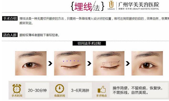 埋线双眼皮多久恢复？这几类人不适合做埋线双眼皮