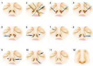 鼻翼缩小整形术有危险吗？手术对比图及过程