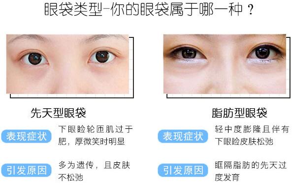 做眼袋手术多久能恢复正常？眼袋大到能装下硬币