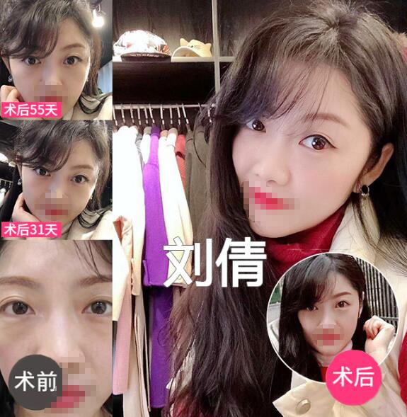 做眼袋手术多久能恢复正常？眼袋大到能装下硬币