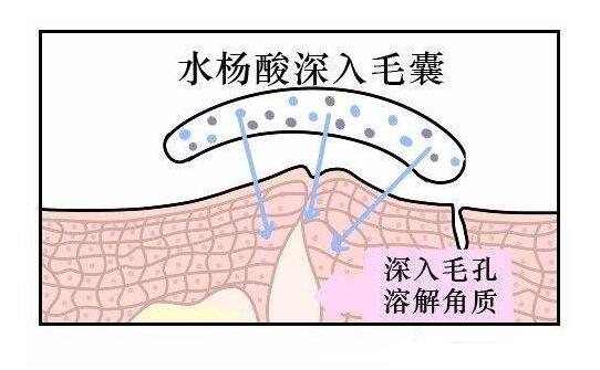 水杨酸祛痘痘、痘印真的有果吗？敏感肌我劝你别尝试！