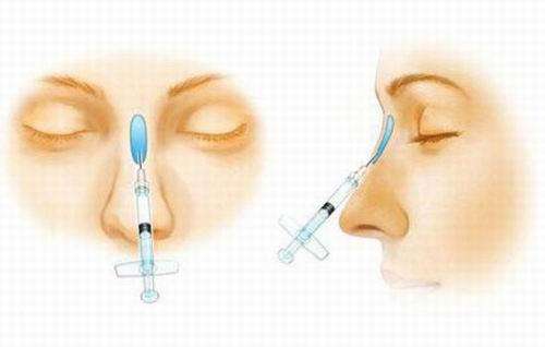 鼻子注射玻尿酸的间隔时间多长才好？