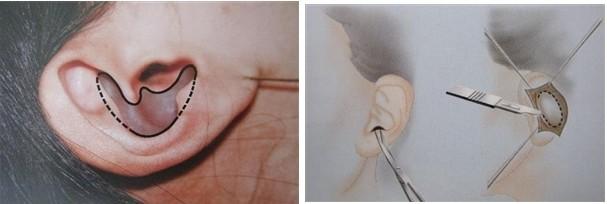 这3种自体软骨移植隆鼻术，肋骨、耳软骨、鼻中隔如何选