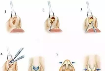 这3种自体软骨移植隆鼻术，肋骨、耳软骨、鼻中隔如何选