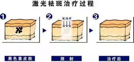 黄褐斑怎么消除？有办法吗？听说黄褐斑很难除掉