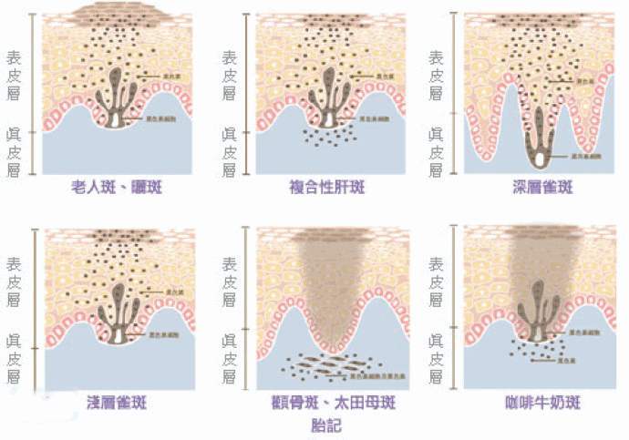 黄褐斑怎么消除？有办法吗？听说黄褐斑很难除掉