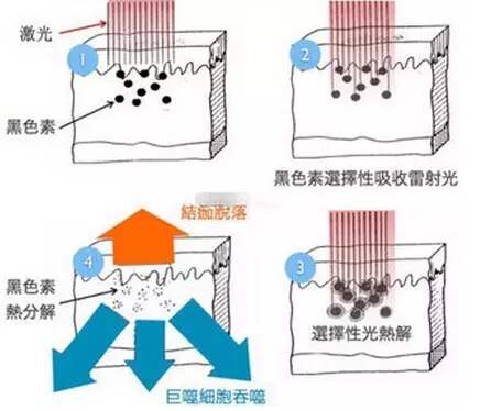 黄褐斑怎么消除？有办法吗？听说黄褐斑很难除掉