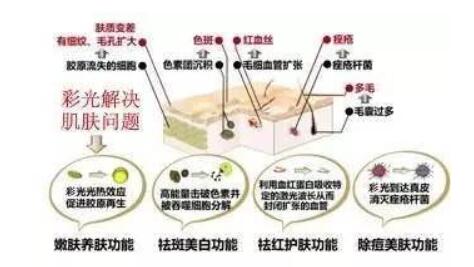 看似很没问题？彩光嫩肤副作用竟然有这些