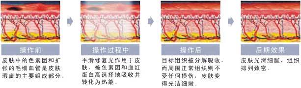 看似很没问题？彩光嫩肤副作用竟然有这些