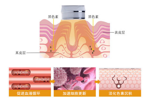 有朋友问：光子嫩肤祛痘印的作用大不大？