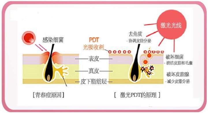 多年痘痘肌，脉冲激光祛痘能彻底治好痘痘和痘印吗？