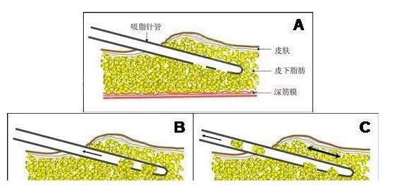 腹部吸脂手术的危害：很多人不知道的腹部吸脂这几大危害！