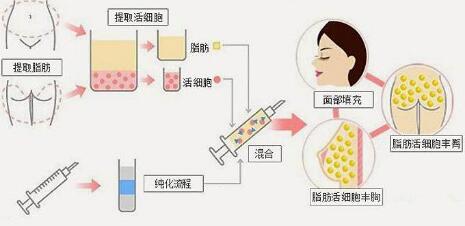 面部脂肪填充后脸特别油是什么情况？【解答】