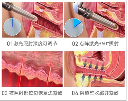 阴道缩紧术注意事项，术前术后护理须知！