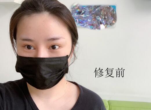 曹仁昌修复双眼皮靠谱吗？技术及介绍盘点