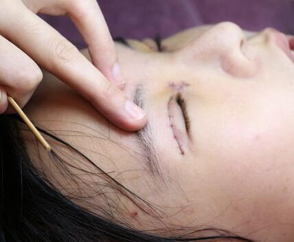 在上海美联臣做的生物焊接双眼皮，7天就能修炼成大眼镁铝！
