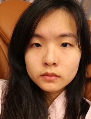 在上海美联臣做的生物焊接双眼皮，7天就能修炼成大眼镁铝！