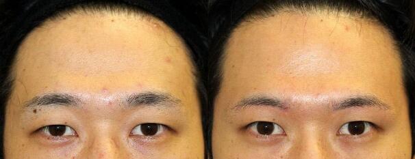 男性过大下颌角+鼻部整形改变后，颜值也能璨如天星！