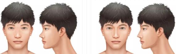 男性过大下颌角+鼻部整形改变后，颜值也能璨如天星！
