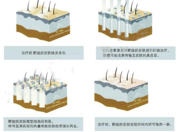 像素激光祛痘得做几次？祛痘的正确打开方式~