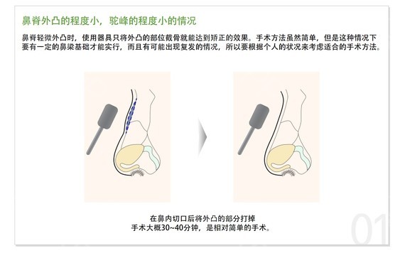 术前了解一下：驼峰鼻整形费用大概多少钱？