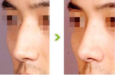 术前了解一下：驼峰鼻整形费用大概多少钱？