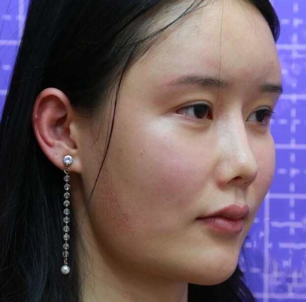 下颌角磨骨术恢复期的详细经历及术后感受，大公开！