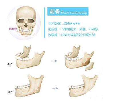 磨腮削骨手术原理