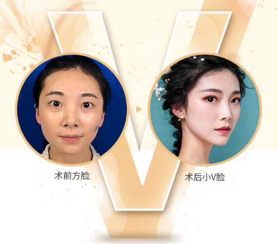 下颌角截骨术有这些危害！