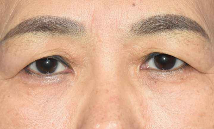 上眼皮松弛切除手术多少钱？术后你品一品