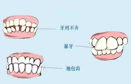 【介绍】牙齿矫正后的果让我觉得不做会后悔一辈子