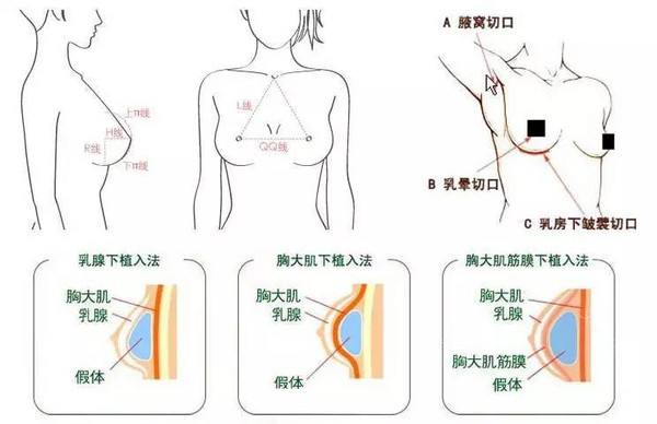 假体隆胸方法靠谱吗、没问题吗？你想知道的都在这儿