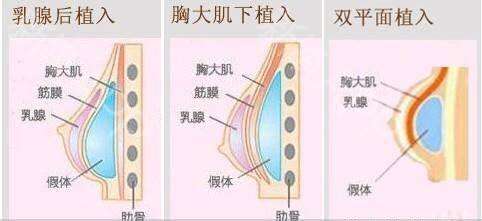 假体隆胸方法靠谱吗、没问题吗？你想知道的都在这儿