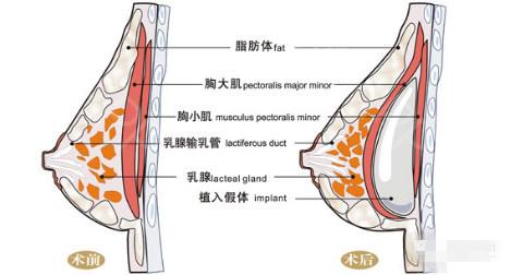 假体隆胸方法靠谱吗、没问题吗？你想知道的都在这儿