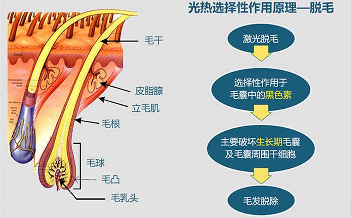 怎么样脱毛才能够没问题又彻底？这个方法可以一劳永逸！