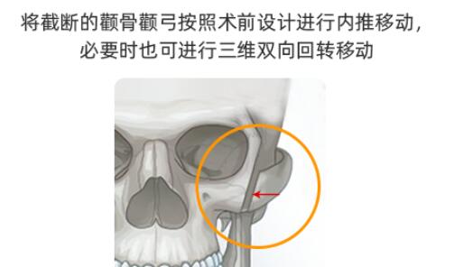 颧骨截骨内推的后遗症分解一二三，抓紧了解！