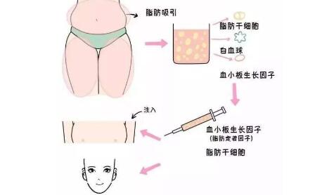 眼窝脂肪填充完有硬块，可能你还没有度过恢复期~