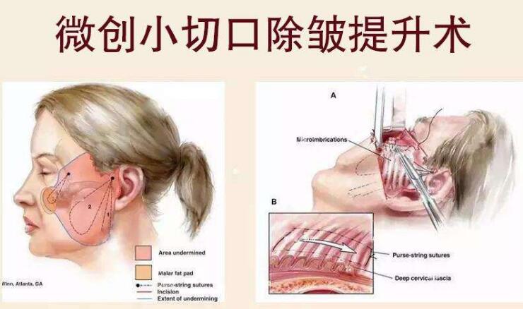 拉皮的副作用大吗？都是“危言耸听”！