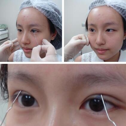 胡瑾医生双眼皮案例：我也有卡姿兰大眼睛辣