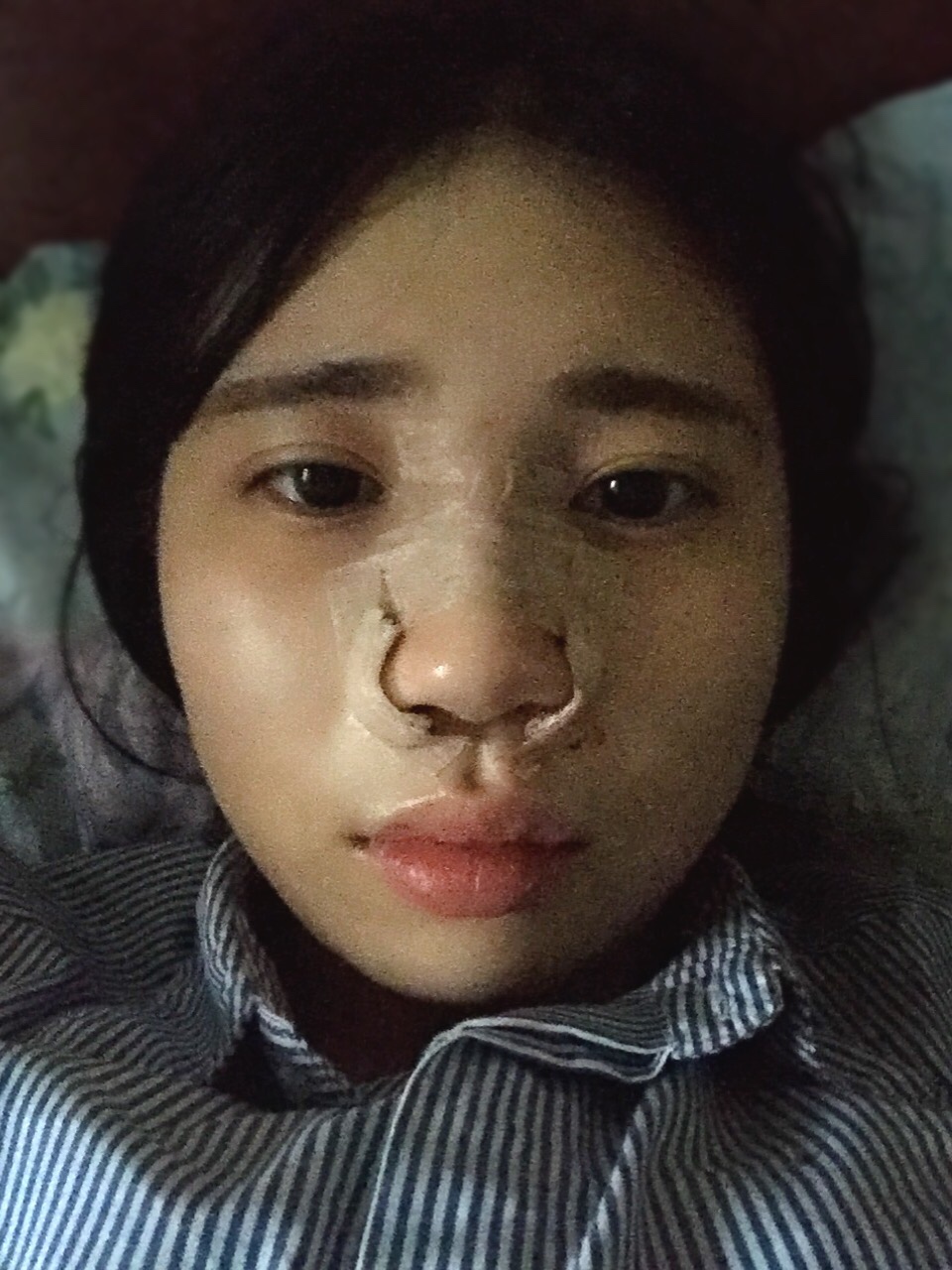 [介绍]鼻骨缩窄手术体验：拯救了我的丑鼻子！