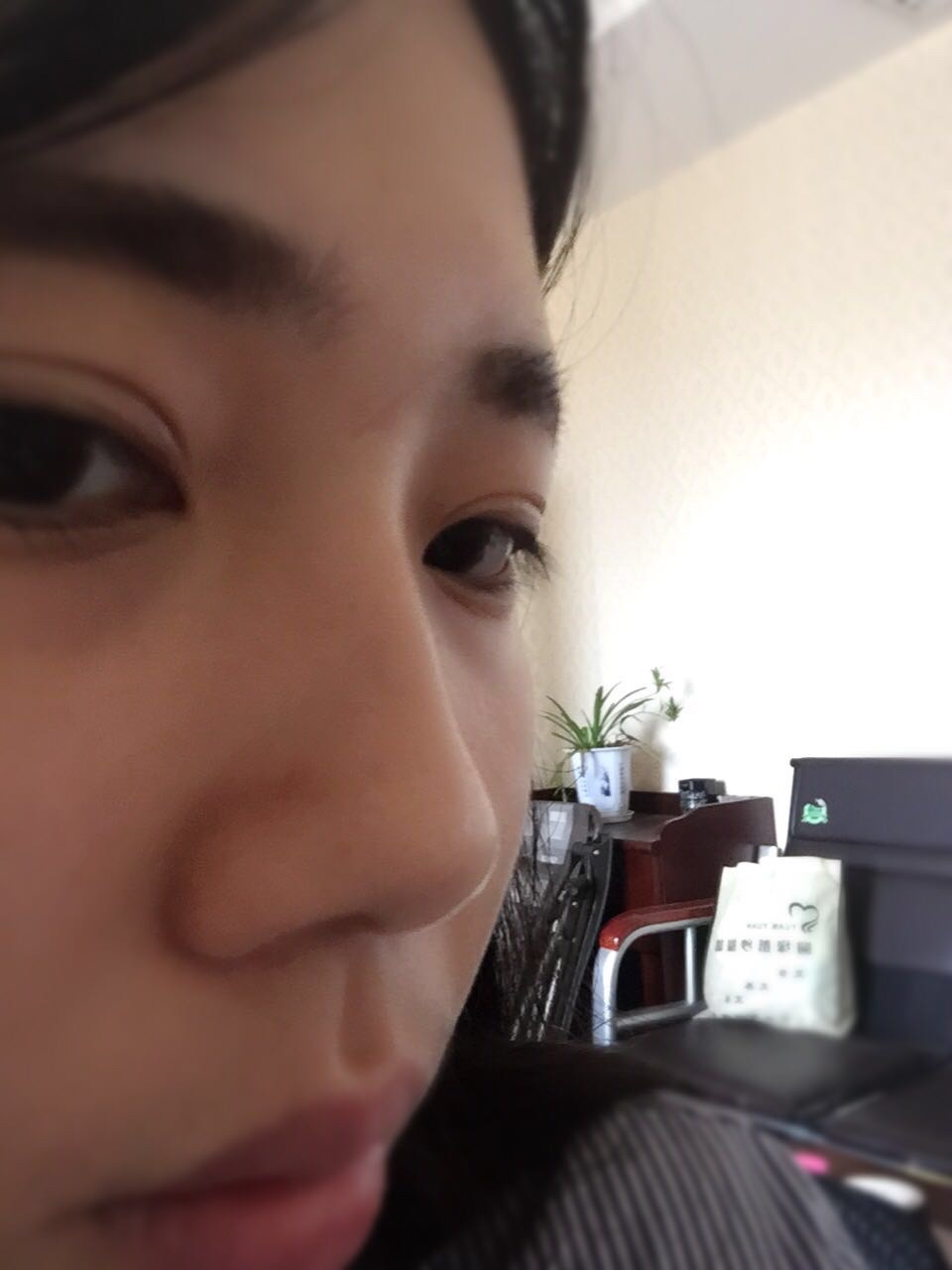 [介绍]鼻骨缩窄手术体验：拯救了我的丑鼻子！