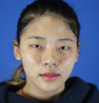林秋蓉激光祛斑果太赞！终于摆脱“斑花”称号了！