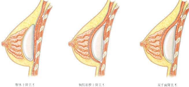 细思极恐！丰胸后遗症有哪些？