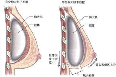 丰胸后遗症